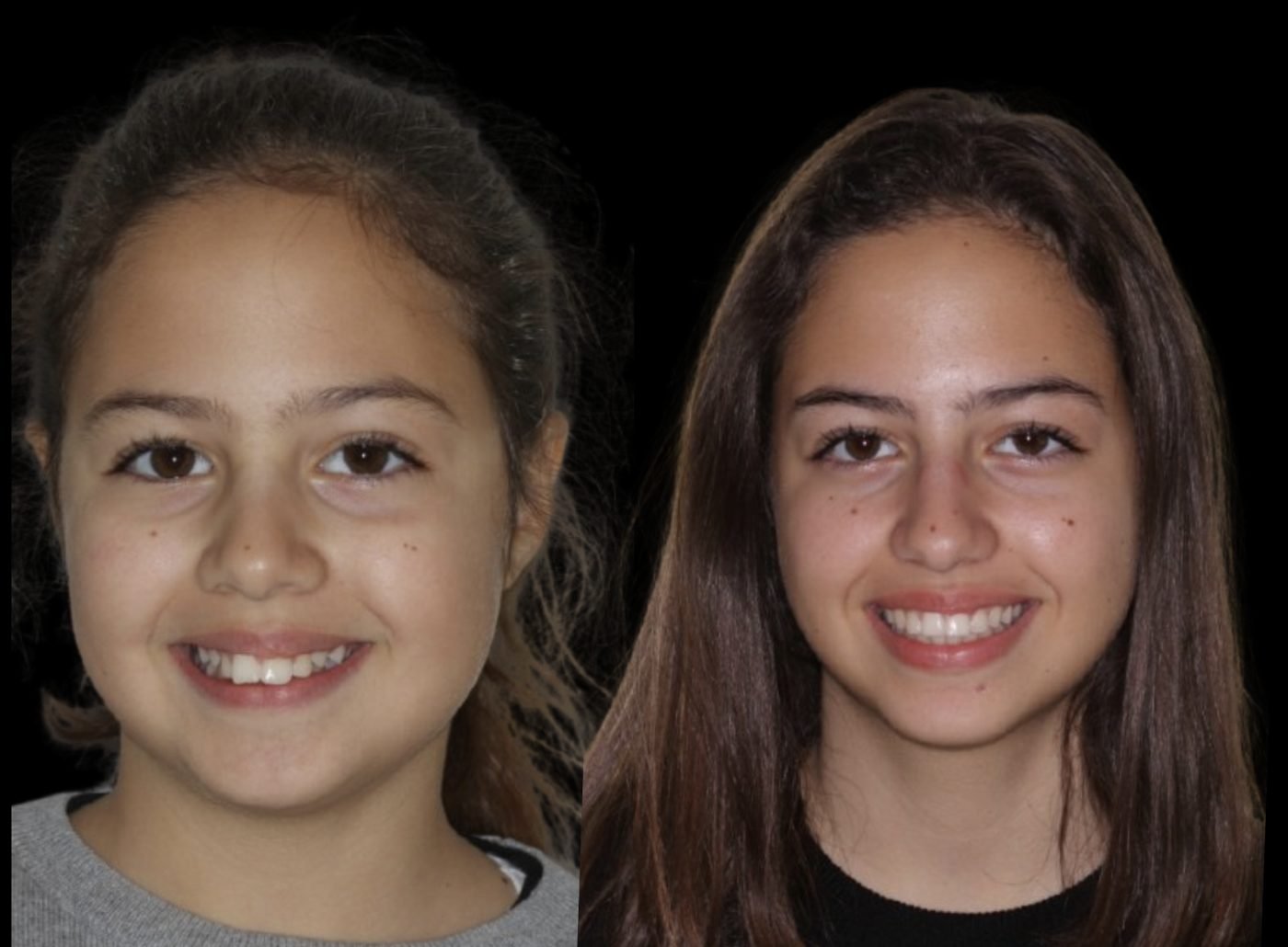 Before and after orthodontic treatment, case 01