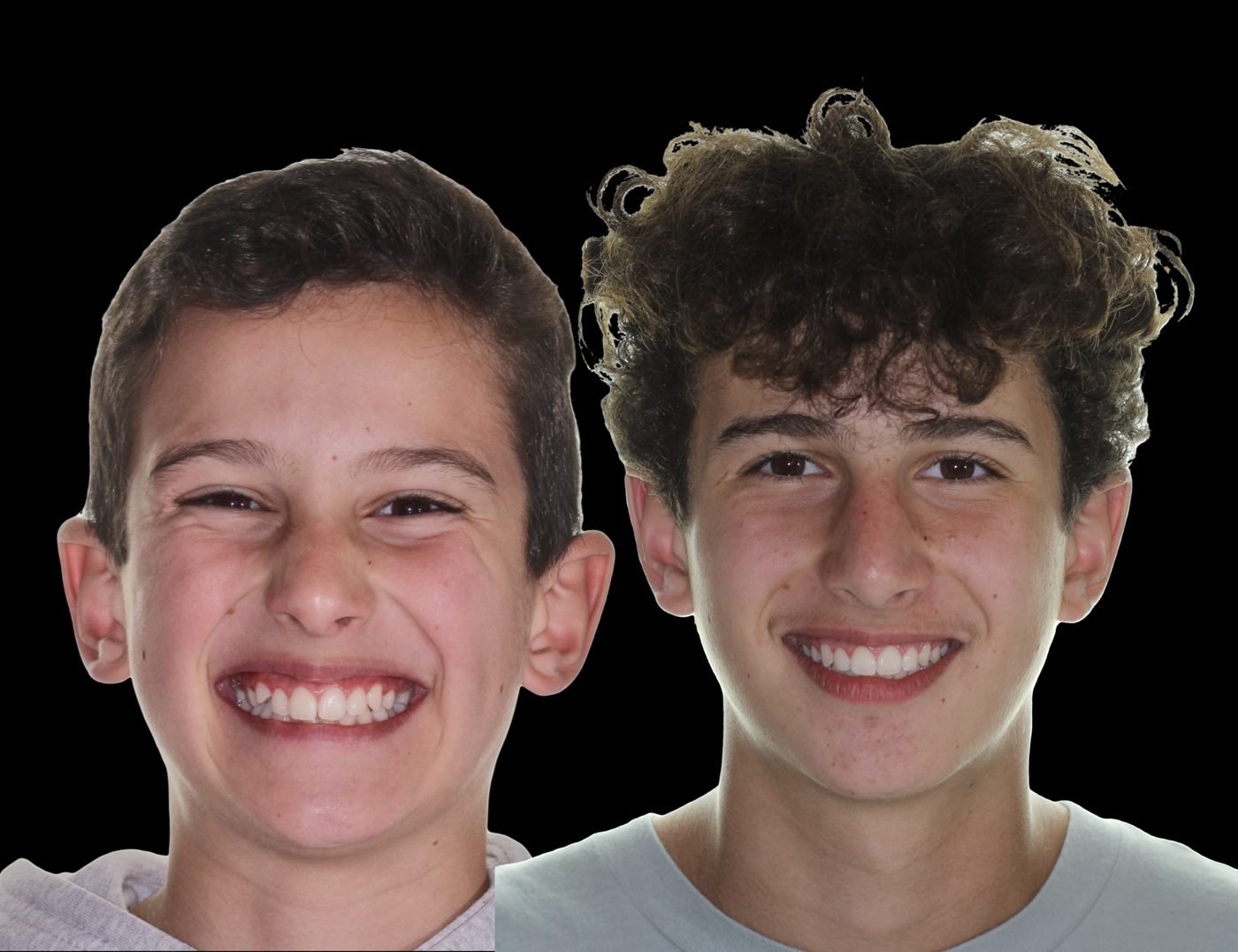 Before and after orthodontic treatment, case 02