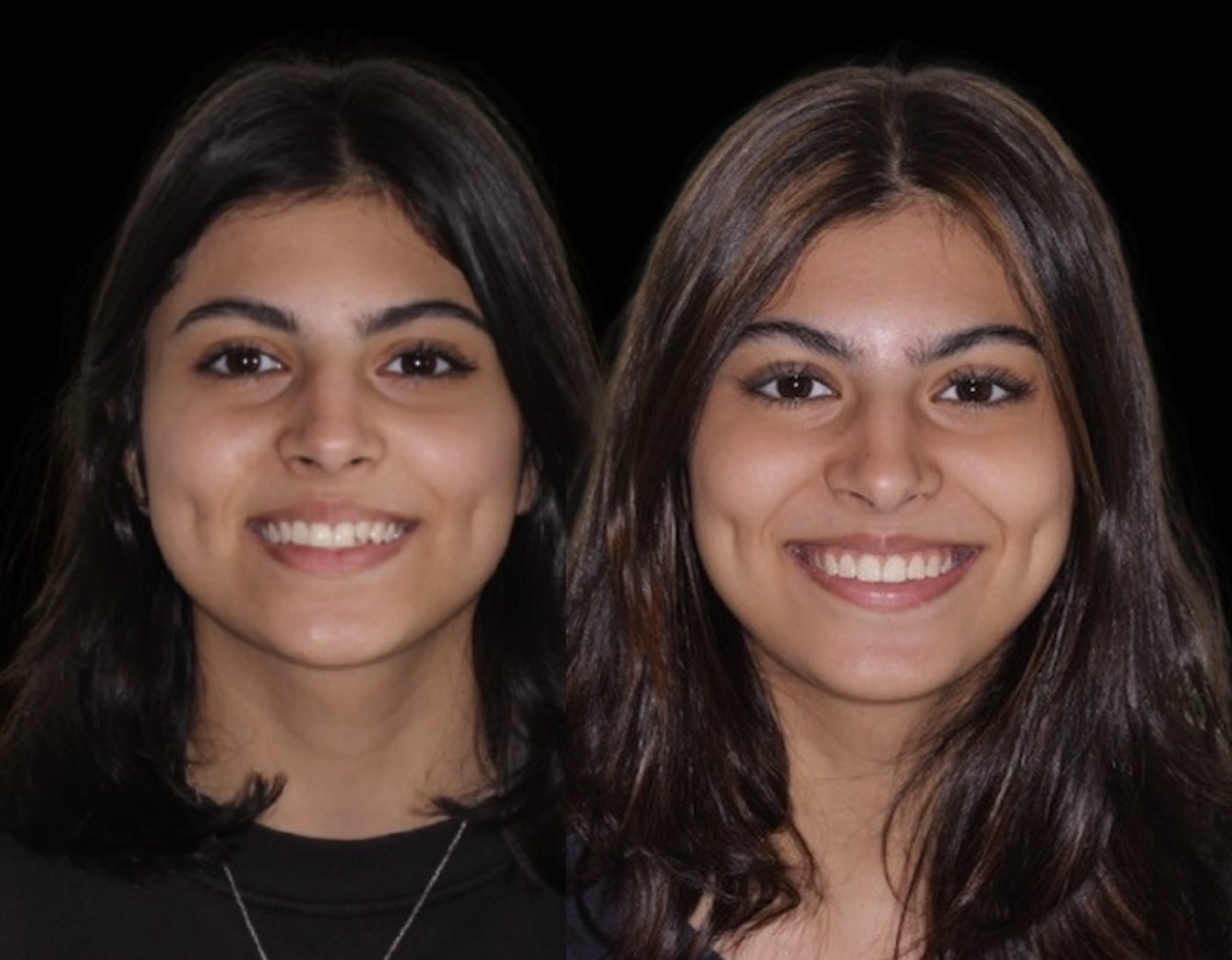 Before and after orthodontic treatment, case 03
