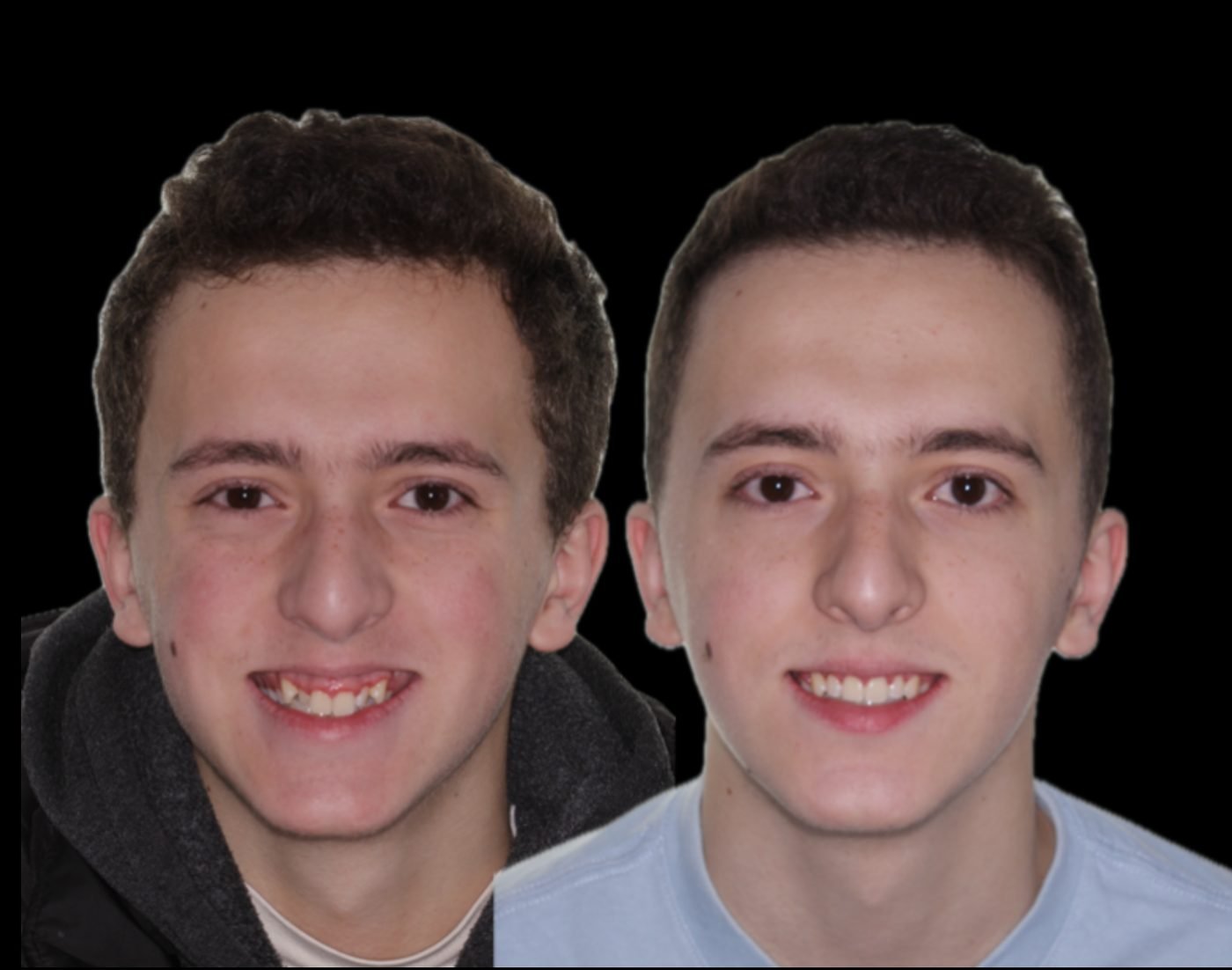 Before and after orthodontic treatment, case 04