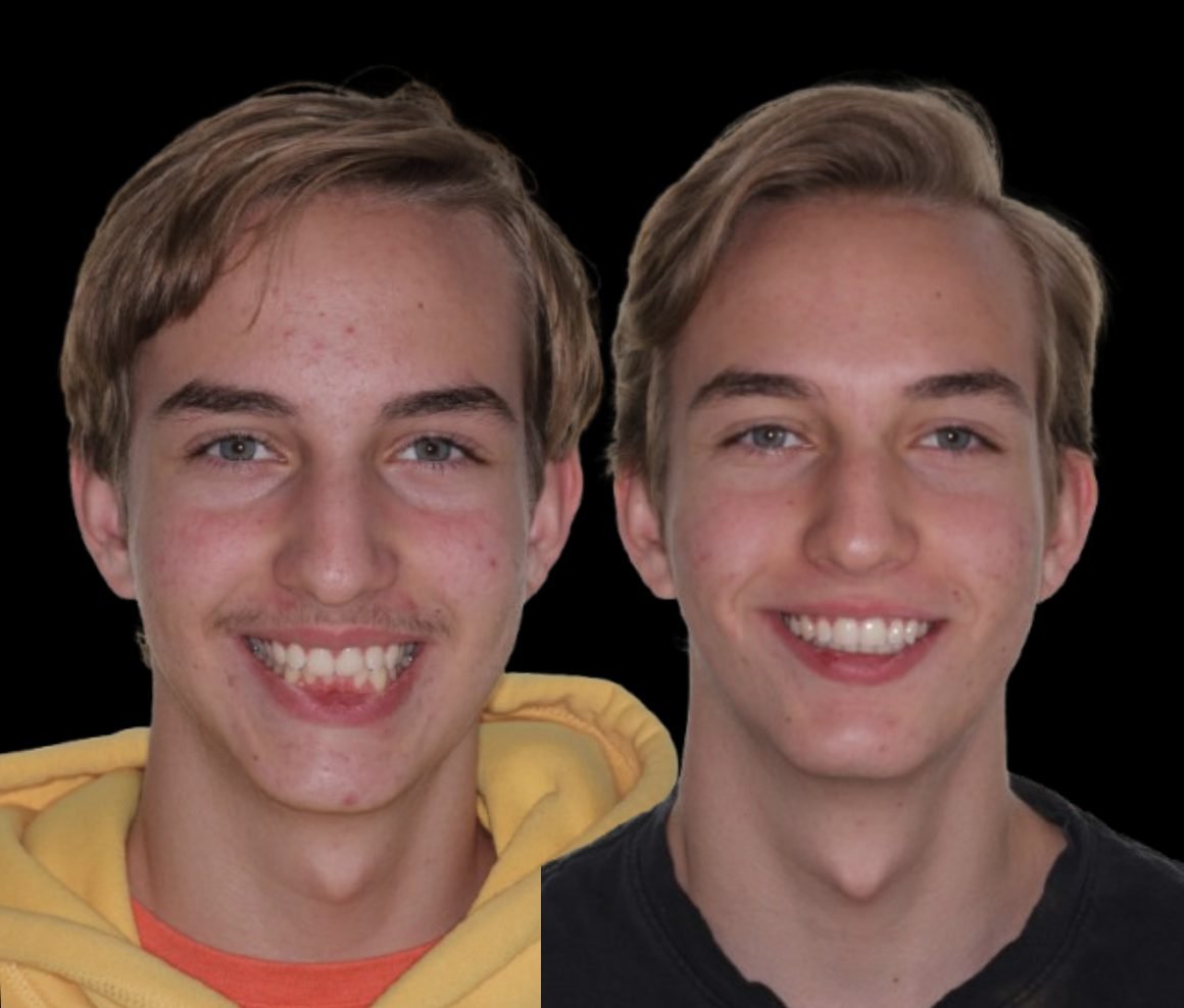 Before and after orthodontic treatment, case 05