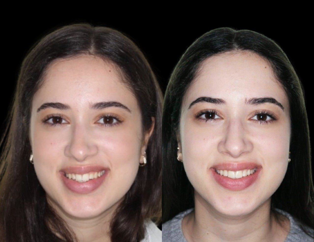 Before and after orthodontic treatment, case 06